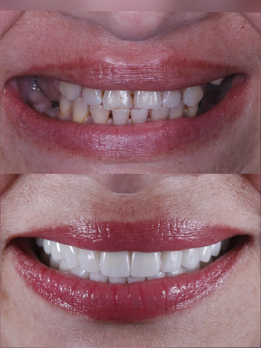 Before & After